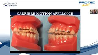 WEBINAR Carriere Motion Appliance [upl. by Salesin948]