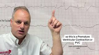 EKG analysis of PVC’s Premature Ventricular Contractions [upl. by Wicks403]