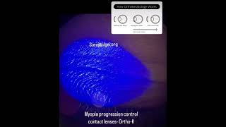 Orthokeratology lens for controlling the myopia progression contactlens orthokeratology [upl. by Hong54]