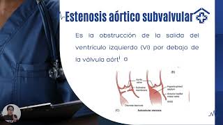 Estenosis aóticaecocardiografía [upl. by Adaner92]