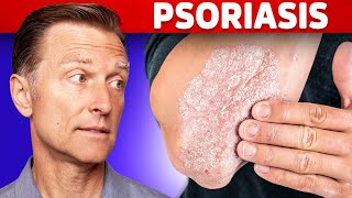 Psoriasis Treatment – The Best 3 Remedies for Psoriasis – DrBerg [upl. by Lajib]