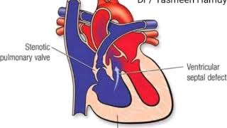 💛 pediatrics 💛 cardio 💙 tetralogy of fallot 💚 [upl. by Eelyme]