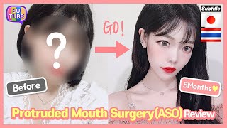 ENJPTH SUB Protruded Mouth Surgery ASO Review Recovery Process 突出口手術 ผ่าตัดปากยื่น [upl. by Retha]