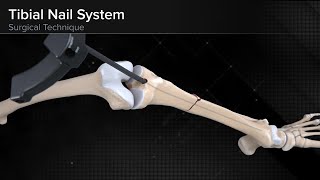 Tibial Nail System—Standard Surgical Technique [upl. by Ferd]