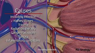 Ureteral Stricture  KU Urology [upl. by Ailic964]