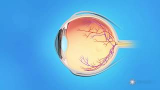 What causes a retinal tear or detachment [upl. by Lamphere]