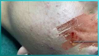 Big Cystic Acne Blackheads Extraction Blackheads amp Milia Whiteheads Removal Pimple Popping [upl. by Felton]