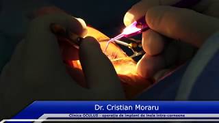 Dr Cristian Moraru  Operatie de implant de inele intracorneene cu tehnologia femtoLaser [upl. by Rog]