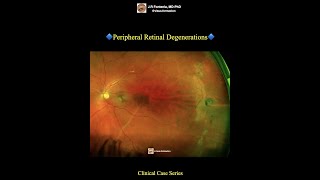 Peripheral Retinal Degenerations [upl. by Lihkin]