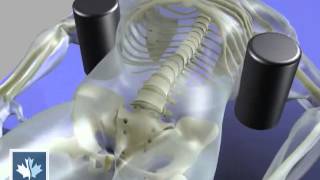 Sciatica  Spinal Decompression  Back Clinics of Canada [upl. by Haughay100]