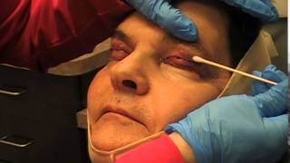 Blepharoplasty and Facelift Recovery  Carmel IN Dr Mark Hamilton [upl. by Engen]