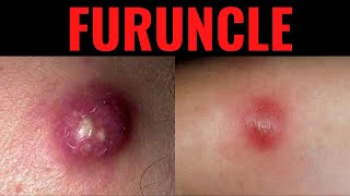 What is Furuncle Furuncle Boil DefinitionCauses Symptoms Risk Factors USMLE [upl. by Lebbie132]