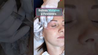 Secretos para eliminar bolsas malares sin cirugía radiofrecuencia ultherapy mesoterapia hifu [upl. by Naras]