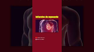 Infarctus du myocarde [upl. by Agem]