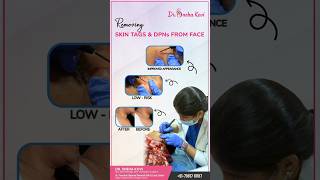 Say Goodbye to Skin Tags and DPNs from Face with Dr Sneha Kovi [upl. by Lowis309]