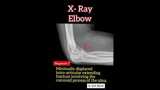 Coronoid process of the ulna fracture   Diagnosis  Radiology [upl. by Anaik]