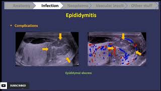 scrotal ultrasound  everything u should know  part 1 [upl. by Anallij]