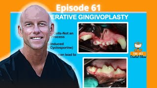 Ep 61  Do you recommend electrosurgery for cases of gingival hyperplasia [upl. by Forrer]