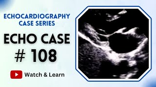 ECHO CASE 108  Echocardiography For Beginners [upl. by Noyar]