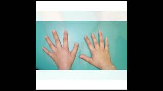 Brachydactyly Treatment  Symptoms and Causes  Diagnosis  Prevention health [upl. by Alyose]