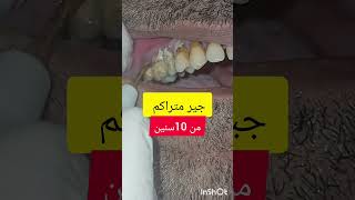 ازالة وتنظيف جير و تقليح الاسنان dentist stitch اكسبلور stitchlover ترند [upl. by Llesig607]