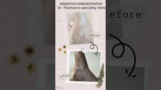 skincare skindisease skinissues skinandhomoeopathy tips healthtalks eczema pyoderma [upl. by Lantha466]