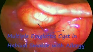 Laryngology  Multiple Epiglottic Cyst in Habiual Smoker with Allergy [upl. by Niessuh]