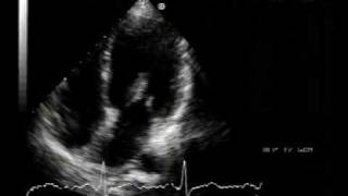 echocardiogram  chordal rupture 22 [upl. by Eseuqram]