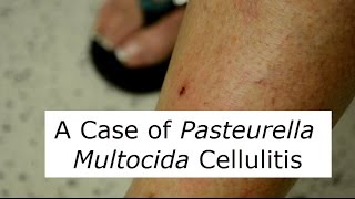 P Multocida Cat Scratch Infection [upl. by Beaston607]