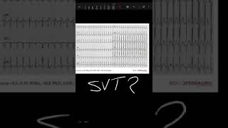 اسمها SVT ولا AVNRT [upl. by Nobel]