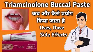 TESS Mouth paint  Tess Mouth Ulcer Gel Review in hindi  Triamcinolone oromucosal paste bp 01 ww [upl. by Kantor]