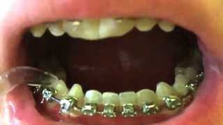 Braces  How to use a waterpik [upl. by Asabi]