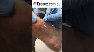 Callus removal in podiatry clinic by cutting debriding with a scalpel [upl. by Ainotahs]