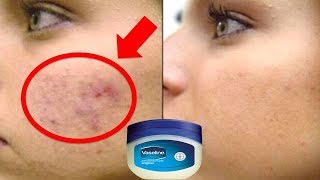 कैसे Vaseline से 3 दिन में चेहरे से दाग धब्बे मुँहासे के निशान झाइयों को गायब करें Vaseline Hacks [upl. by Ariuqahs921]