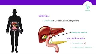 Gallstone Ileus and Riglers Triad [upl. by Hana]