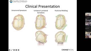 Craniosynostosis [upl. by Ronoel]