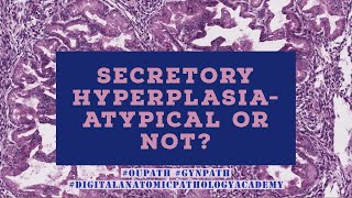 Secretory Hyperplasia Atypical or Not [upl. by Asuncion]