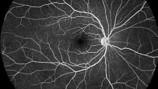 Fundus fluorescein angiography FFA [upl. by Aneram]