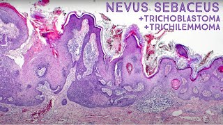 Tumors Growing from Nevus Sebaceus Trichilemmoma amp Trichoblastoma Dermpath in 5 Minutes [upl. by Dion]