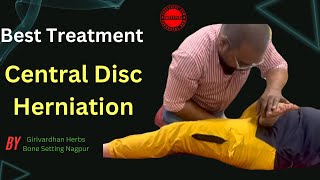 A Central Disc Herniation Is A Rare Condition  Disc Herniation Recovery [upl. by Aissela]