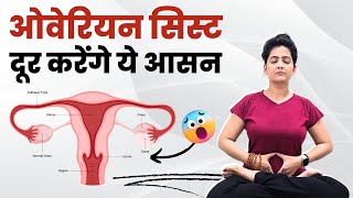 ओवेरियन सिस्ट की समस्या दूर करेंगे ये आसन  Cure Ovarian Cyst [upl. by Litton928]