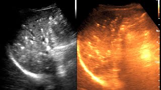 Diffuse Hepatic granuloma  CKD  Ultrasound cases 5 of 2000 [upl. by Schnurr]