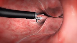 What Happens During the Endoscopic Sleeve Gastroplasty ESG Procedure [upl. by Eeimaj]