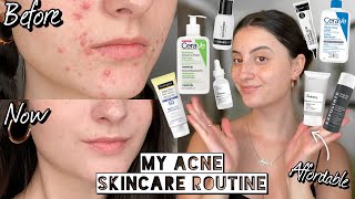 How I Cleared My HORMONAL ACNE amp SCARRING with Affordable Skincare  Dry amp Sensitive Skin [upl. by Anirehtak]