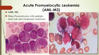 Practical Hematology 12 Morphology of Acute amp chronic leukemia [upl. by Ahtnamys]