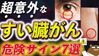 放置厳禁！知らないと後悔するすい臓がんの初期症状。尿、便、皮ふ、目意外な兆候とは？予防法とは？医師が徹底解説。 [upl. by Reham]