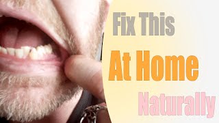 How I fixed my receeding gums at home naturally [upl. by Anaihr208]