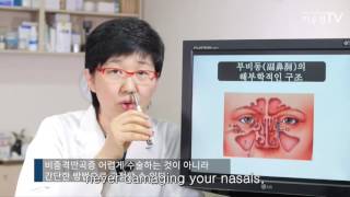 비중격만곡증 비수술치료 Deviated Nasal Septum SurgeryFree Treatment Knowhow [upl. by Euqinahs777]