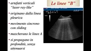 5 Sindrome Interstiziale [upl. by Annid]