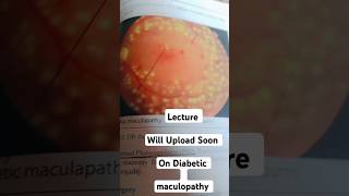 Diabetic maculopathy  Lecture Will Uploaded Soon diabeticretinopathy [upl. by Evot747]